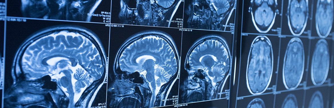 Image for %s“纳米”钢针如何帮助改进脑部手术